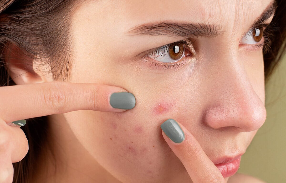 Woman Popping Acne on Face